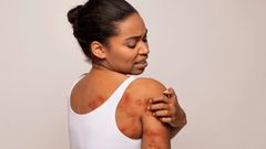 Spot and treat heat rash [Shutterstock]