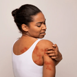 Spot and treat heat rash [Shutterstock]