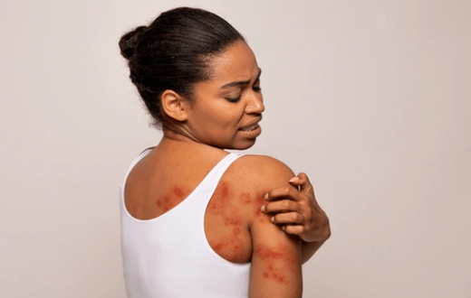 Spot and treat heat rash [Shutterstock]