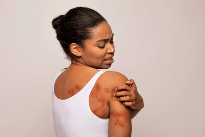 Spot and treat heat rash [Shutterstock]