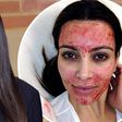 Kim K popularised vampire facials [Dailymail]