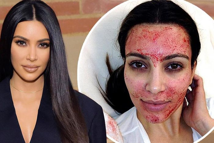 Kim K popularised vampire facials [Dailymail]