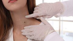 What do birthmarks mean [Children'sSkinCentre]