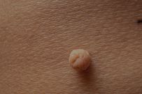 What are skin tags? [LondonDermatology]