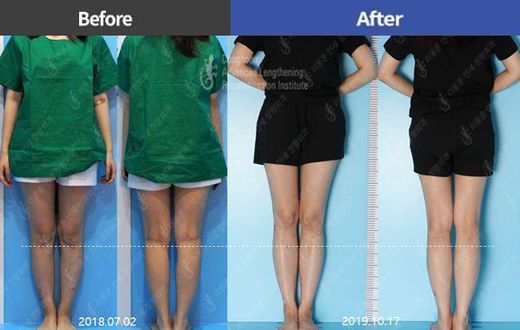 Height surgery