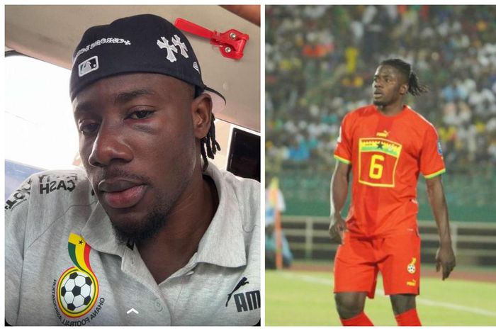 Mohammed Salisu shows his bruised face from battling win against Mali