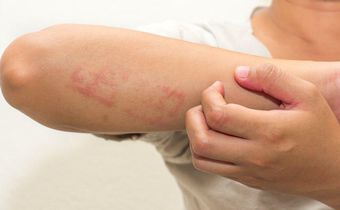 eczema