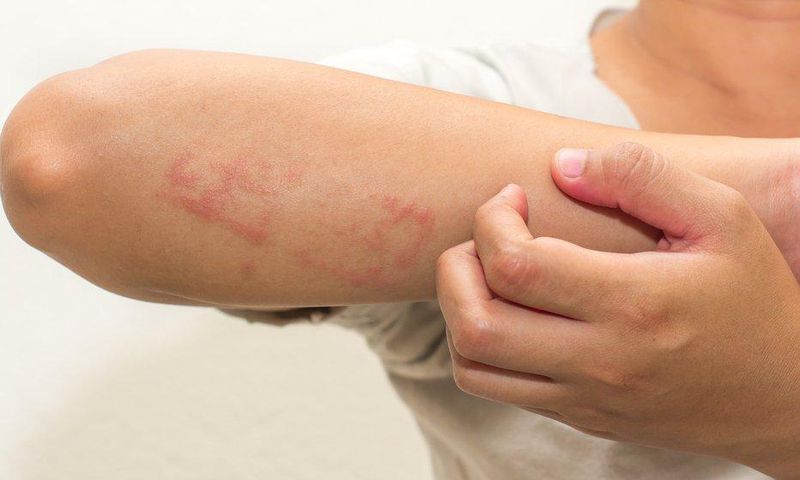 eczema