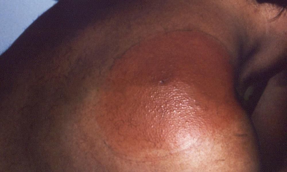 Bacteria and viruses transmitted by ticks pose a serious threat to everyone [Tick Rash]