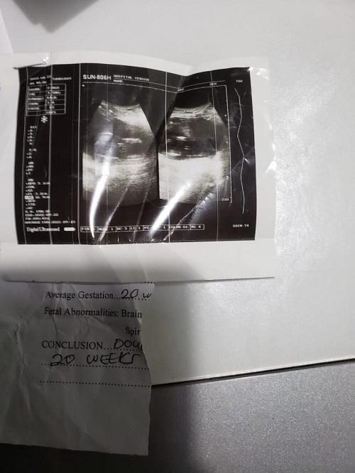 The first ultrasonic scan after 20 weeks showed two foetuses