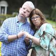 Couple who cannot smile because of a rare disease fall in love
