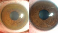 Wilson's disease