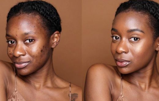 There's an art to concealing pimples [Naakie Nartey]