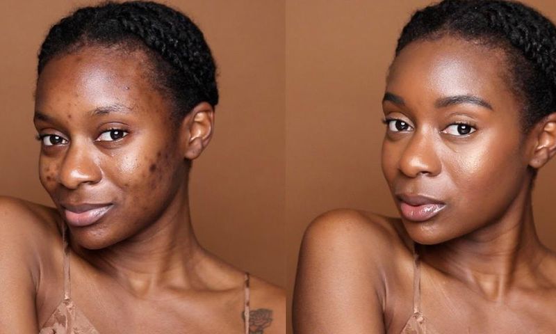 There's an art to concealing pimples [Naakie Nartey]