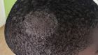 Scalp ringworm