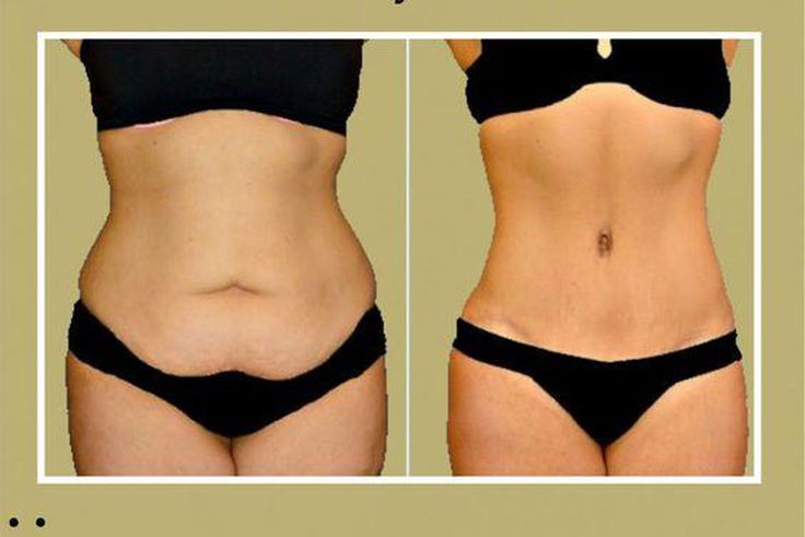 Why does the tummy accumulate fat? [Pinterest]