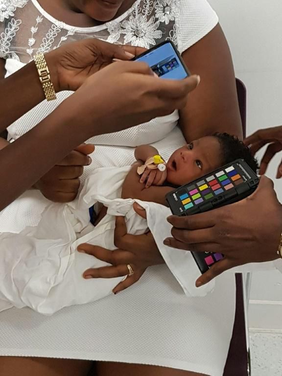 A baby is screened during a trial in a large-scale feasibility study using a smartphone-based screening for jaundice at Greater Accra Regional Hospital in Accra, Ghana in this undated handout photo from the University of Ghana