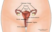Cervical cancer