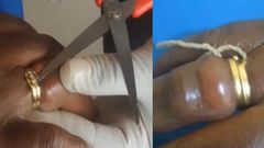 Woman almost lost finger after wearing wedding ring bought from her friend
