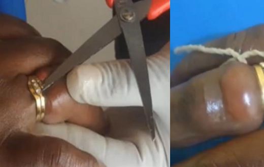 Woman almost lost finger after wearing wedding ring bought from her friend