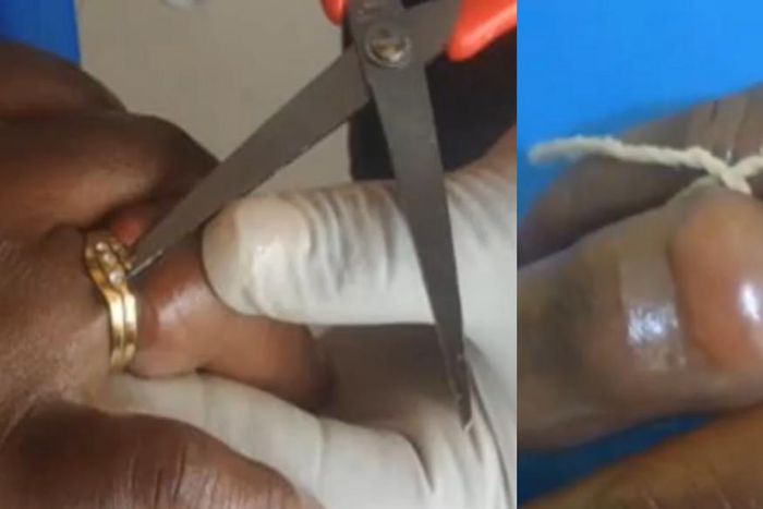 Woman almost lost finger after wearing wedding ring bought from her friend