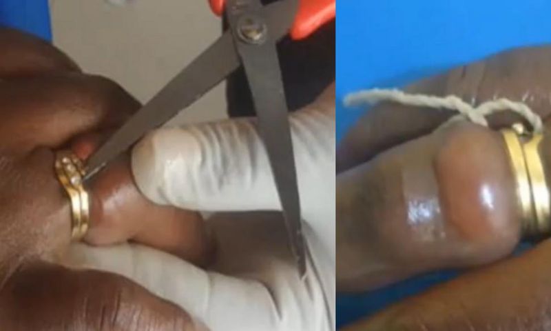 Woman almost lost finger after wearing wedding ring bought from her friend