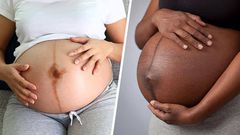 The black line is called linea nigra [The Bump]