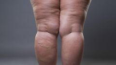 Habits that cause cellulite(inquisitr)