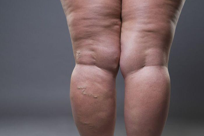 Habits that cause cellulite(inquisitr)
