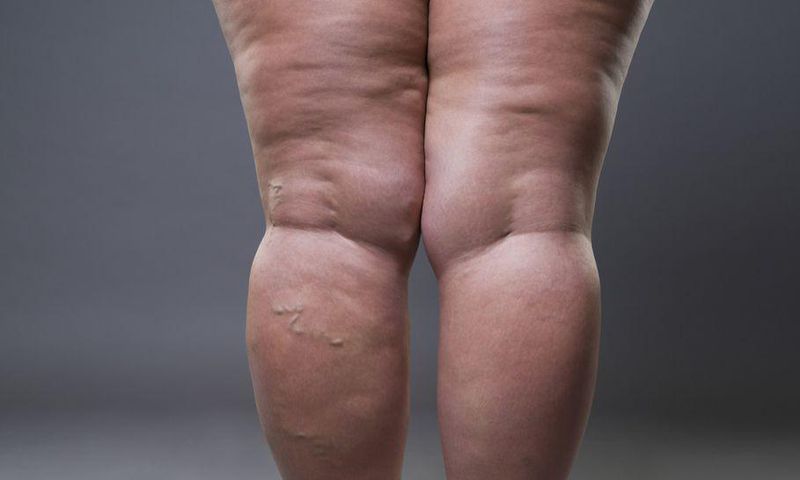 Habits that cause cellulite(inquisitr)