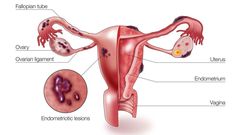 A diagram showing how endometriosis occurs in female reproductive organs