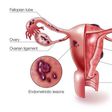 A diagram showing how endometriosis occurs in female reproductive organs