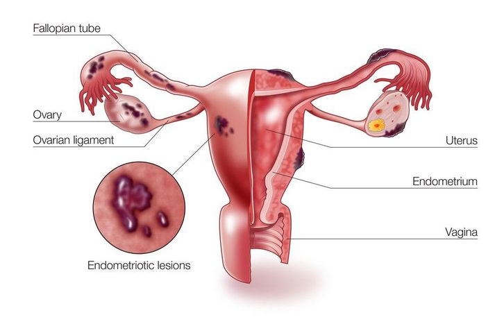 A diagram showing how endometriosis occurs in female reproductive organs
