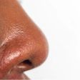 Treating oily nose