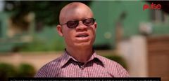 The realities of living with albinism