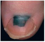 Dark spots on nails- Dr Clement Lo
