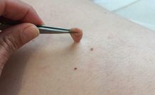 Skin tag removal [LolachiInstitute]