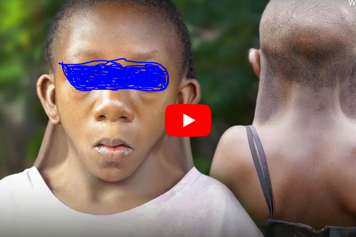 9-year-old girl faces stigma and pin due to her rare condition