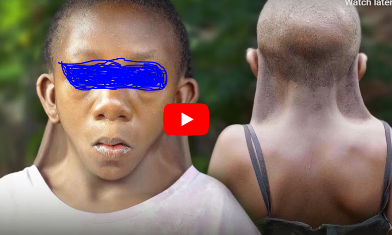 9-year-old girl faces stigma and pin due to her rare condition