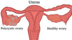 Understanding PCOS [SIUMedicine]