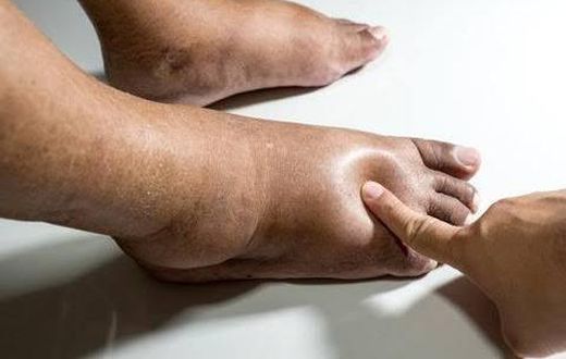 Swollen legs may be as a result of an underlying medical condition [Dr Segal]