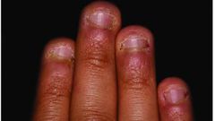 nail biting