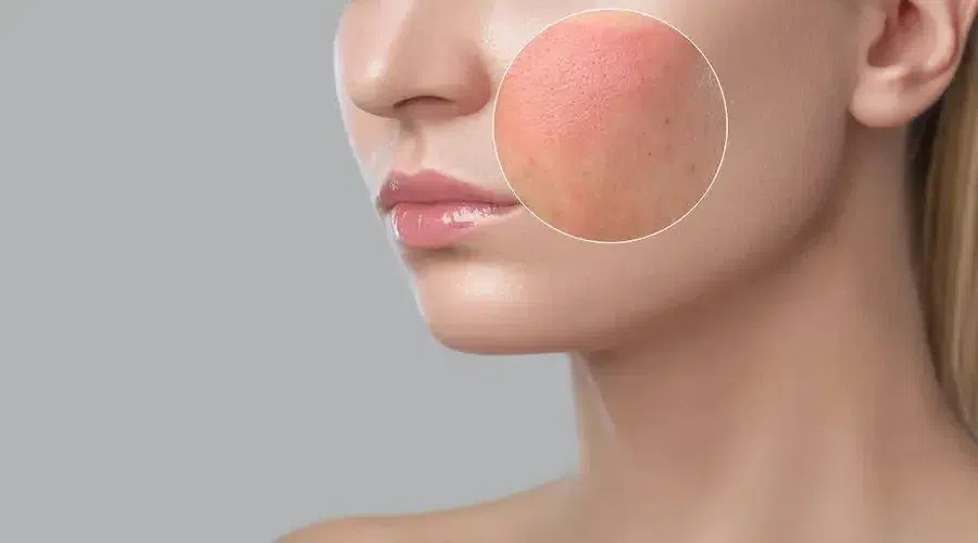 skin-barrier