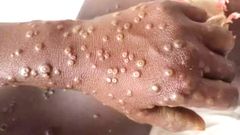 Mpox in Ghana: What you need to know about the re-emerging disease