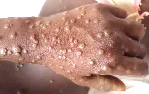 Mpox in Ghana: What you need to know about the re-emerging disease
