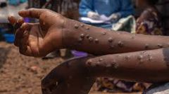 Ghana confirms 22 new Mpox cases, total infections hit 446