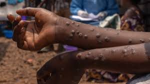 Mpox in Ghana: What to know about the stubborn virus giving health experts tough time