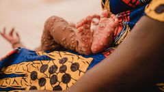 Mpox in Ghana: What to know about the stubborn virus giving health experts tough time