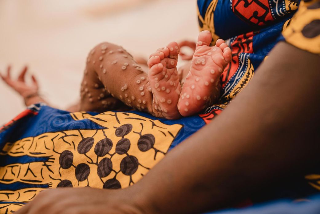 Mpox in Ghana: What to know about the stubborn virus giving health experts tough time