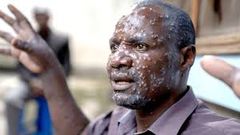 Mpox in Ghana: What to know about the stubborn virus giving health experts tough time